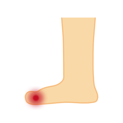 つま先の痛みのイラスト